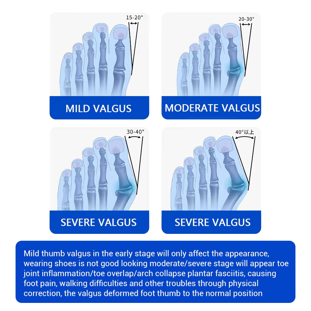 Knob-Adjustable Bunion Corrector & Big Toe Straightener – 180° Rotatable Hallux Valgus Adjuster with Heel Strap & Silicone Cushion